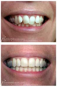 Effective Teeth Straightening Near Albert Park